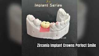 All Zirconia Implant Crowns Bridges High Quality Aesthetics